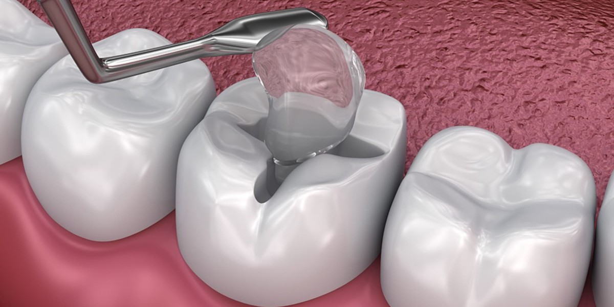 Dental Sealants Market: Demand Dynamics and Influencing Factors