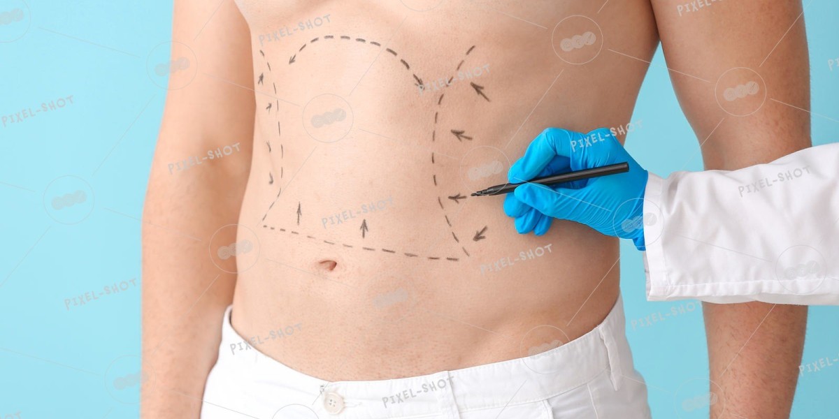 Liposuction Surgery: Riyadh’s Most Popular Fat Reduction Procedure