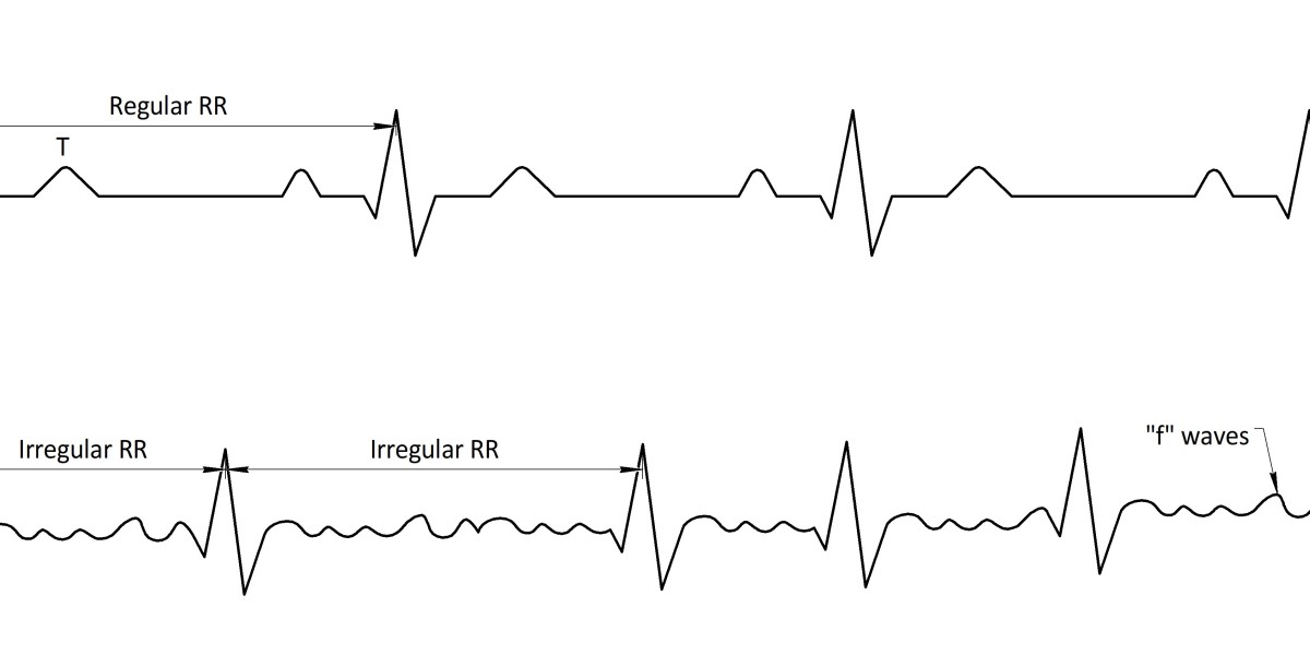 Atrial Fibrillation (Afib) Market: Current Trends and Growth Drivers
