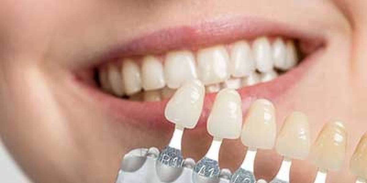Enhancing Your Smile: Traditional vs. Composite Veneers Explained in Dubai