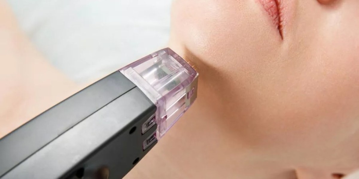 Can Fractional RF Microneedling Address Sunspots and Pigmentation?