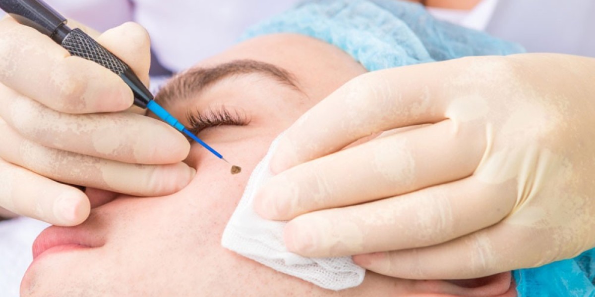 Laser vs Surgical Mole Removal: Options in Riyadh