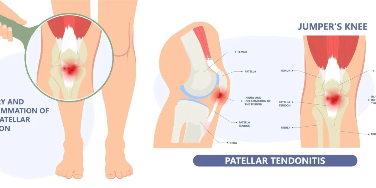 Overcome Jumper’s Knee Effective Treatment Options at Progressive Specialists