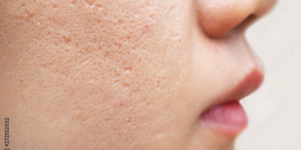 Before and After: Acne Scar Treatments in Riyadh