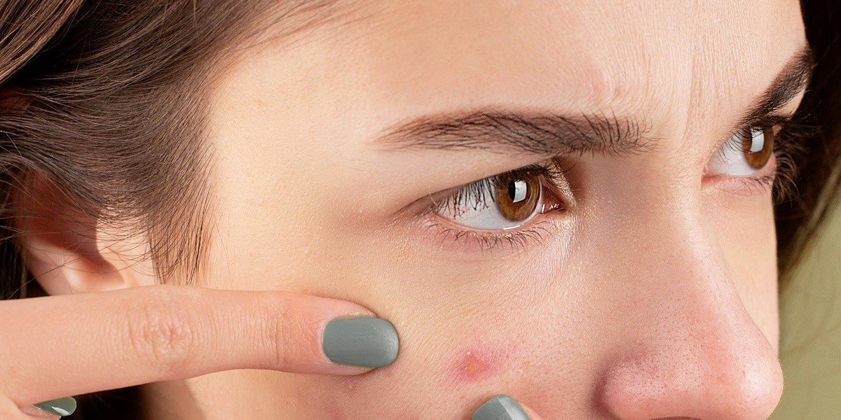 Clearer Skin with Acne Scar Removal in Islamabad
