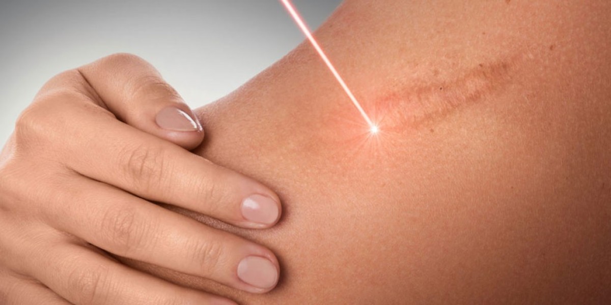 5-Star Laser Scar Removal Clinics in Riyadh