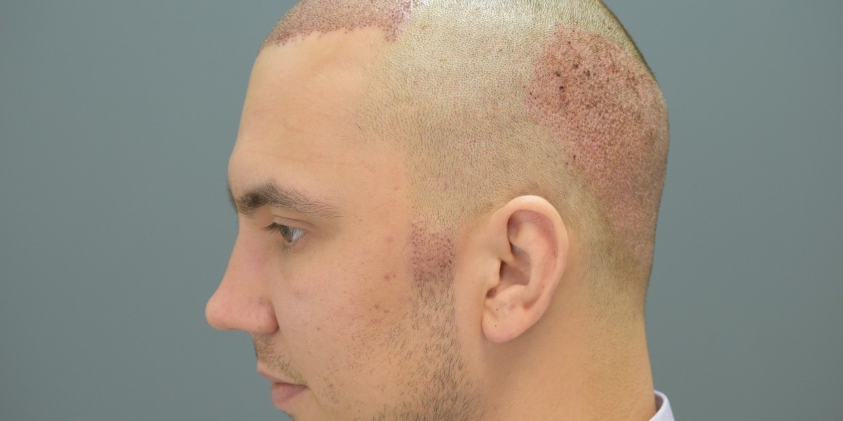 Assessing the Expense-to-Value Ratio of Hair Transplants: Is It Worth the Investment?
