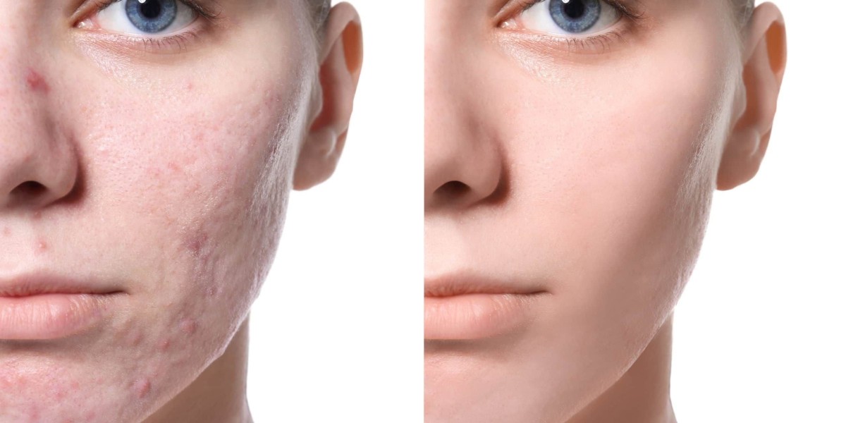 Scar Revision Surgery for Acne: Riyadh Specialists