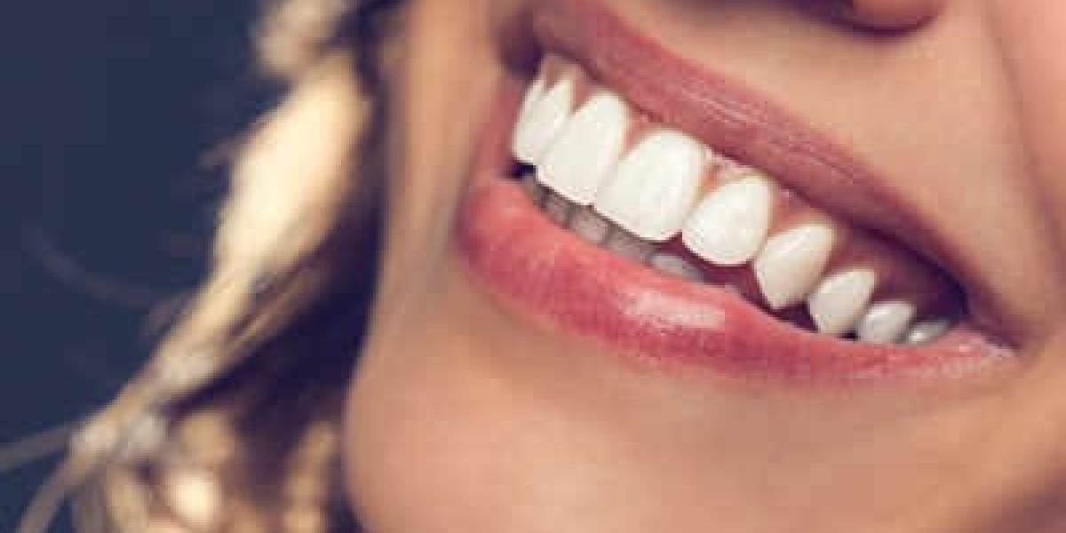 Whitening Your Teeth for a Radiant Smile