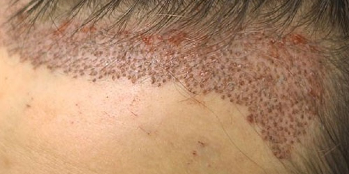 Does transplanted hair grow?