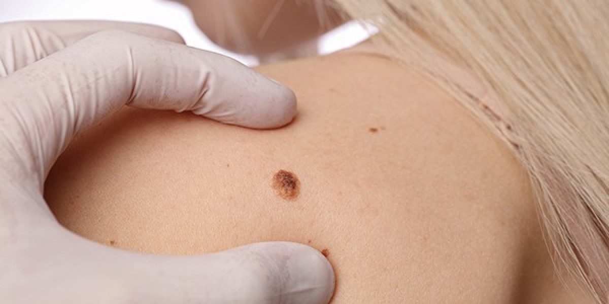 Can Mole Removal Be Done Safely at Any Age?