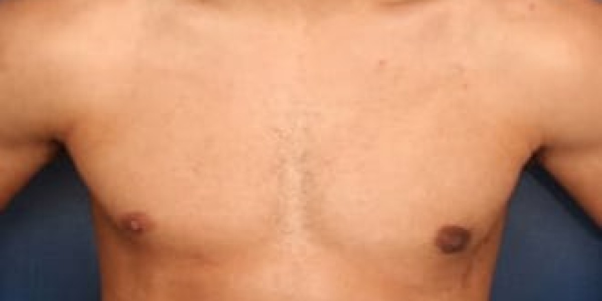 Key Factors to Consider Before Gynecomastia Surgery
