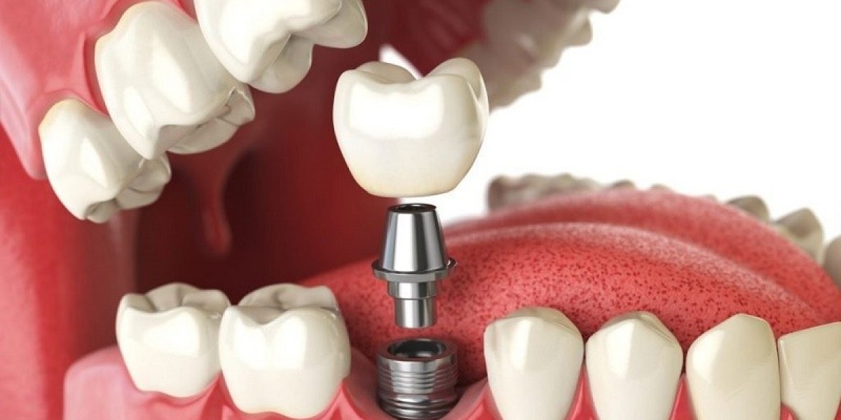 Chi phí cắm implant: Những yếu tố ảnh hưởng và địa chỉ đáng tin cậy