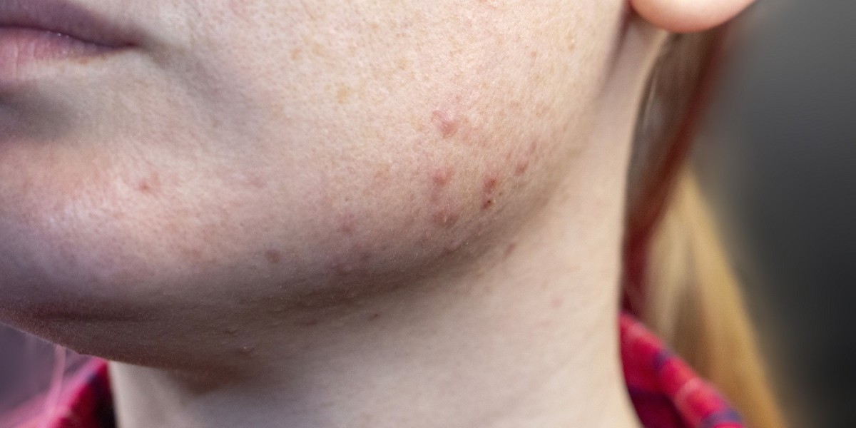 How to Incorporate Acne Treatment into Your Routine