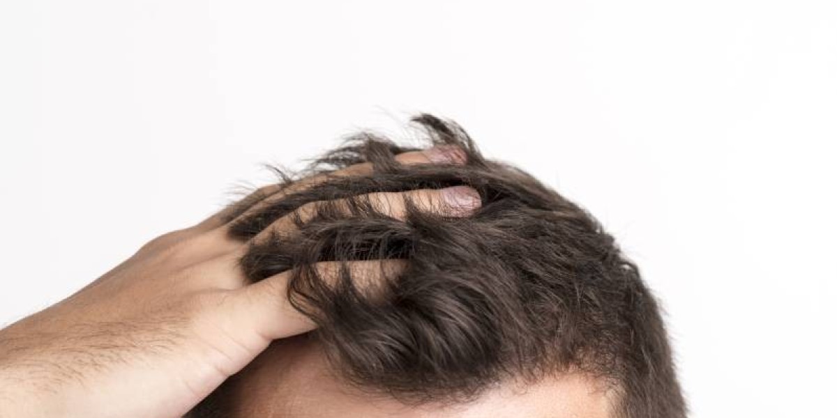 How to improve hairline?