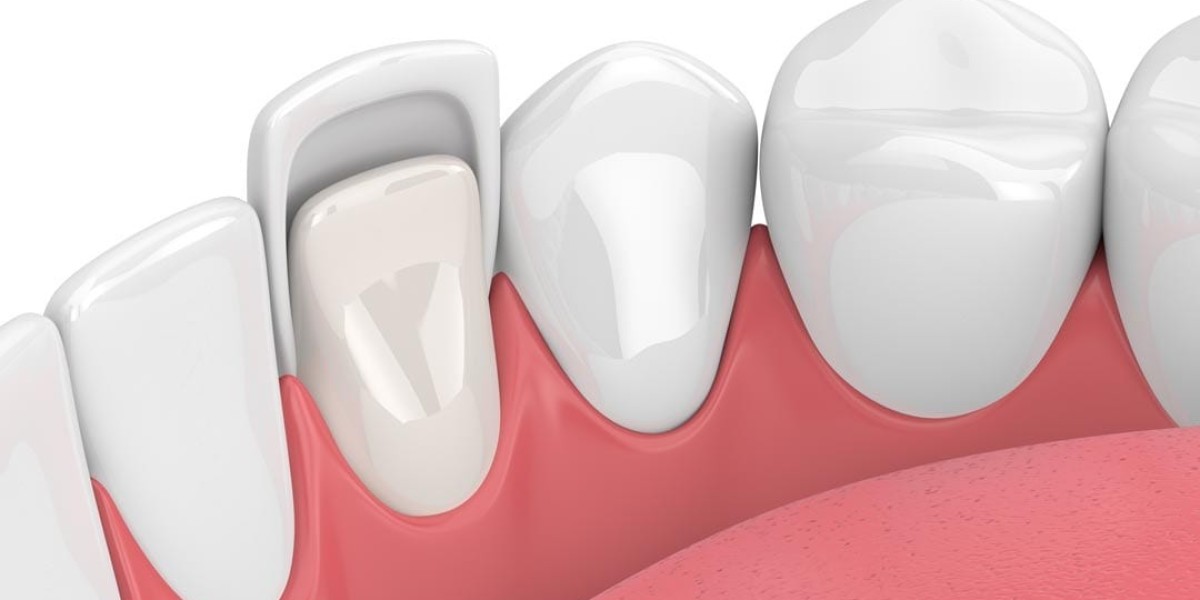 How to Find the Best Price for Dental Veneers in Dubai?