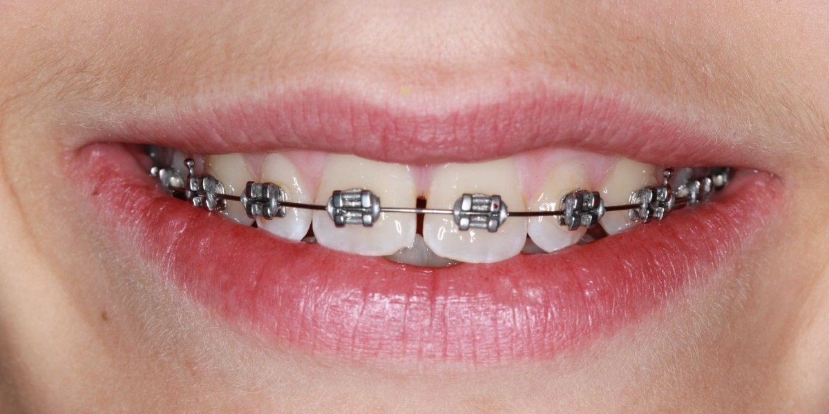 The Price of a Perfect Smile: Understanding Braces Costs in Dubai