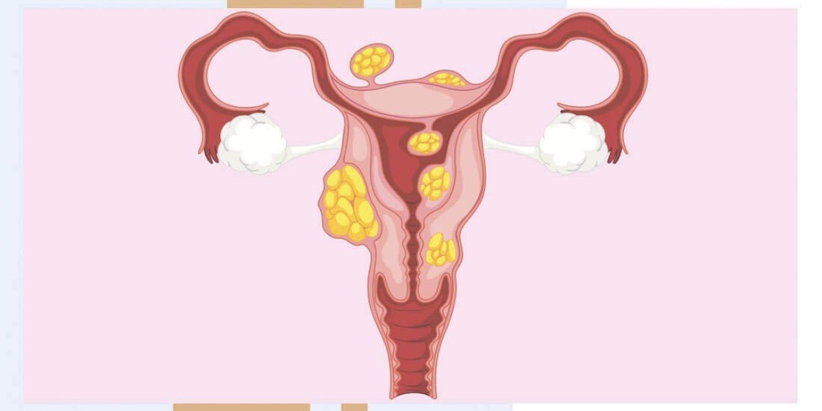 Uterine Fibroid Treatment Market Potential and Key Drivers: Understanding What’s Driving Growth in the Global Market