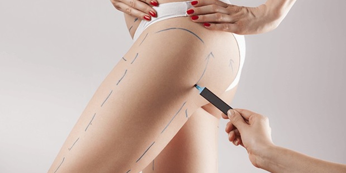 "Achieve Your Dream Shape with Vaser Liposuction in Riyadh – Safe, Effective, and Affordable"