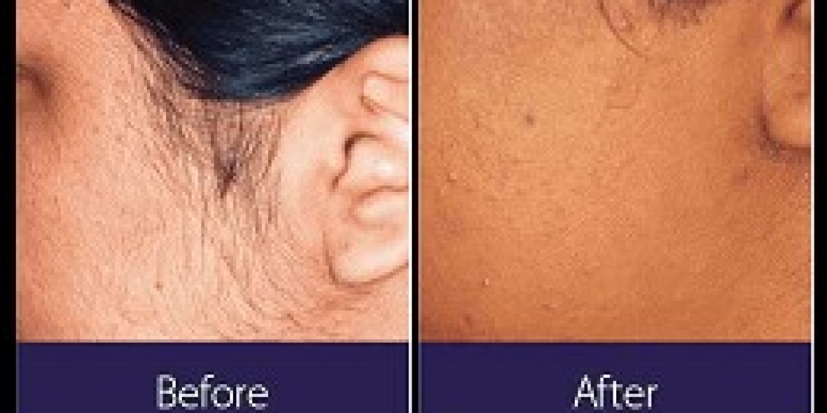 Is Laser Hair Removal Haram? Insights from Religious Scholars