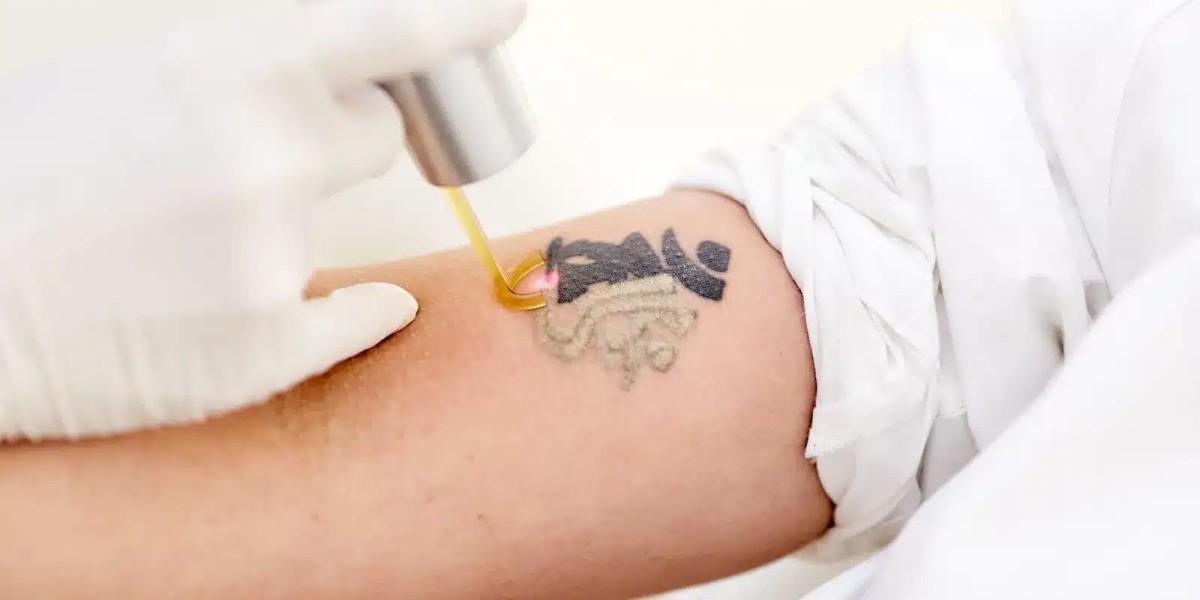 The Complete Guide to Choosing the Best Laser Tattoo Removal Treatment in Dubai