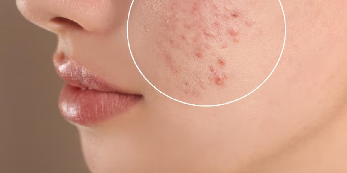 How Long Does It Take for Acne Treatments to Show Results?