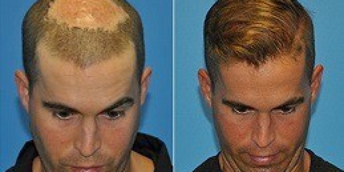 Finasteride: A Non-Surgical Option for Hair Restoration