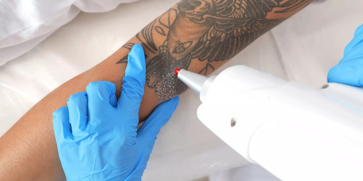 Can Laser Tattoo Removal Be Used for Covering Old Tattoos in Dubai?
