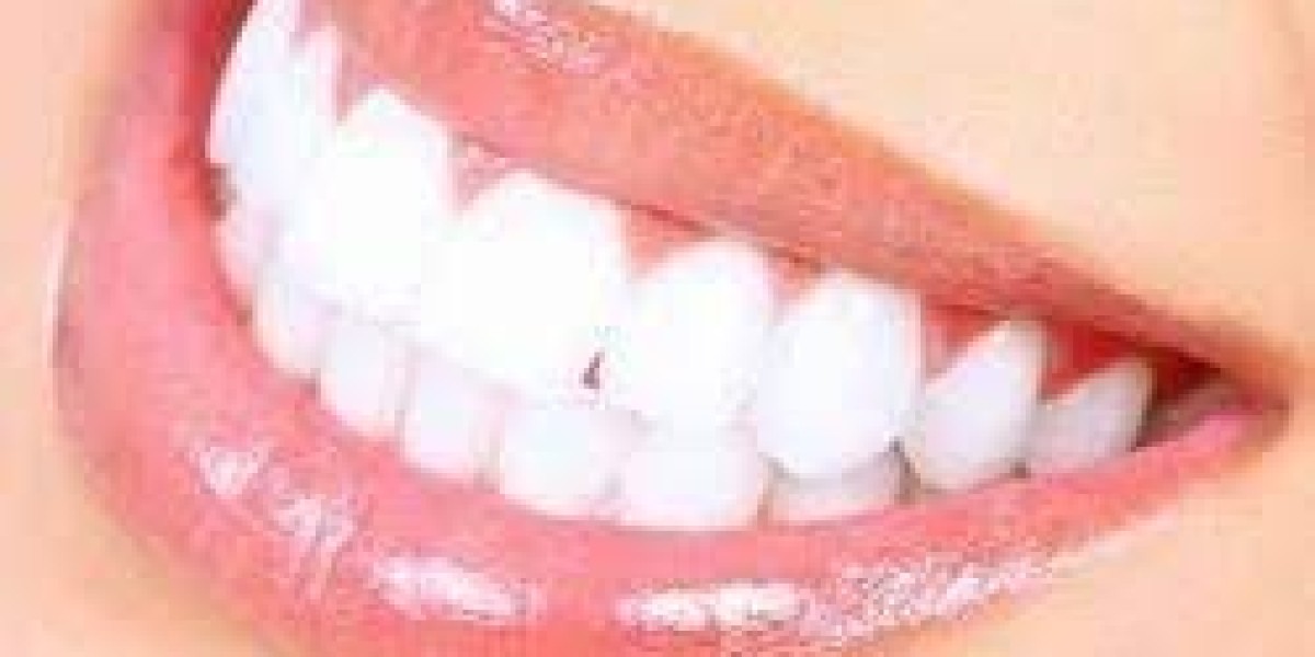 Hollywood Smile Price in Riyadh: Is It Worth the Investment?