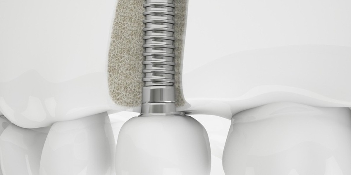 How Dental Implants Can Restore Your Confidence