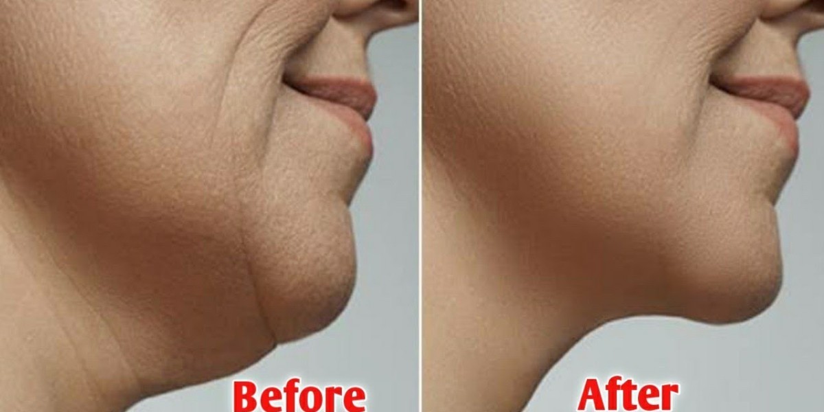 Advanced Cryolipolysis for Double Chin Reduction in Riyadh