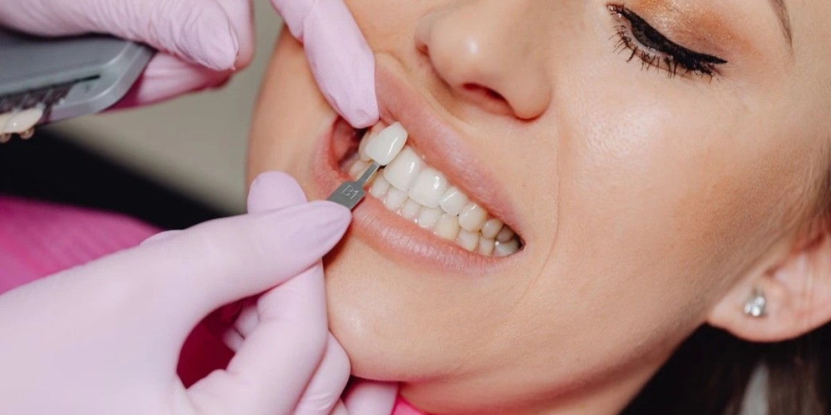 What is the Price Range for Dental Veneers in Dubai?