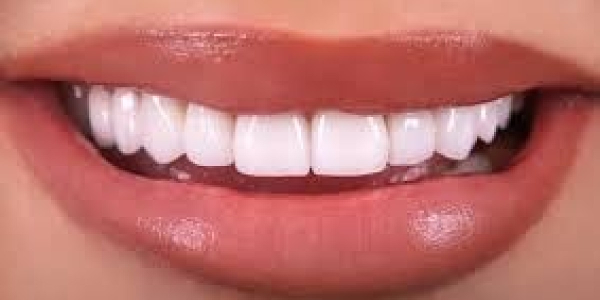 Looking for Dental Veneers in Riyadh? Here’s What to Expect