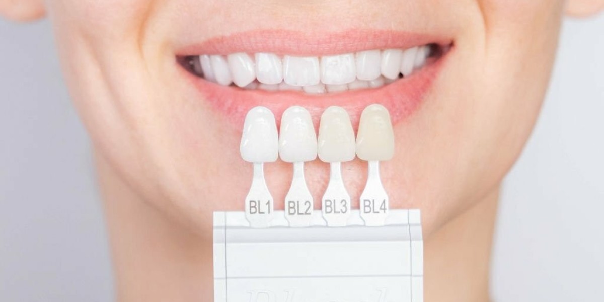 Exploring Dental Veneers Costs in Dubai: What to Expect Before You Smile