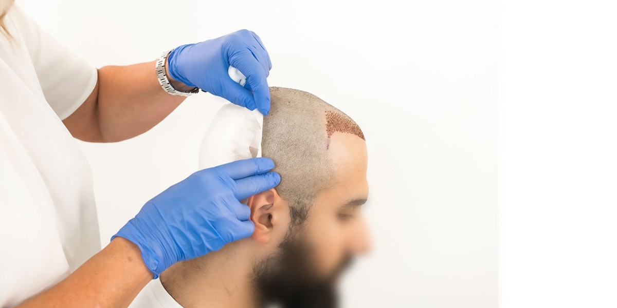 Male vs. Female Hair Transplant Options in Riyadh