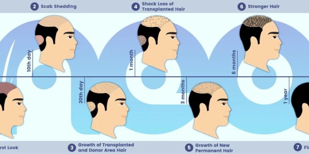 The Benefits of Hair Replacement in Turkey: A Guide to Effective Solutions for Hair Loss