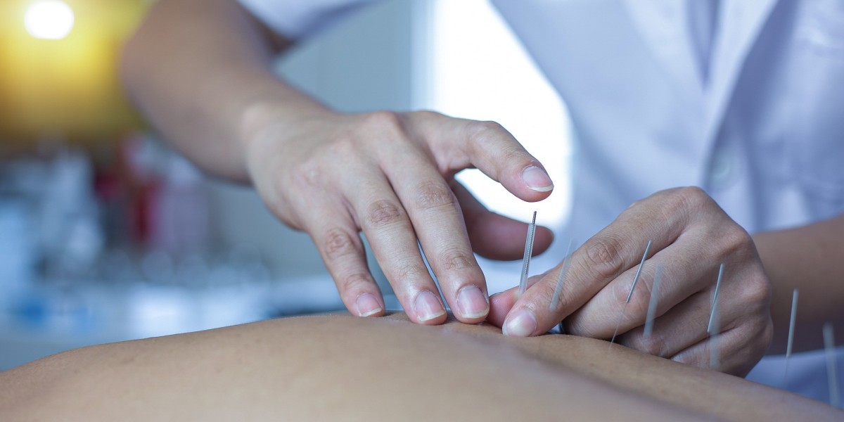 The Benefits of Acupuncture for Migraine Relief