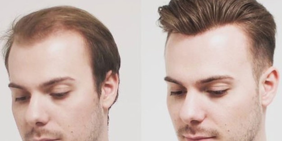 Innovative Approaches to Front Line Hair Fixing in Dubai