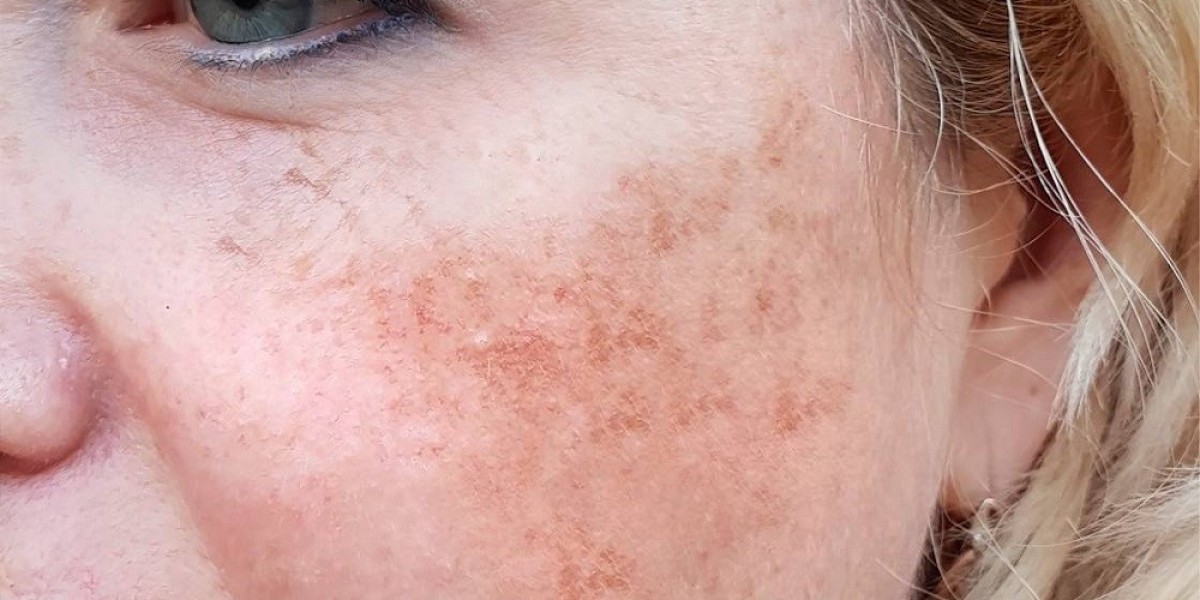 Hydroquinone Treatments for Melasma in Islamabad: Safe or Not?