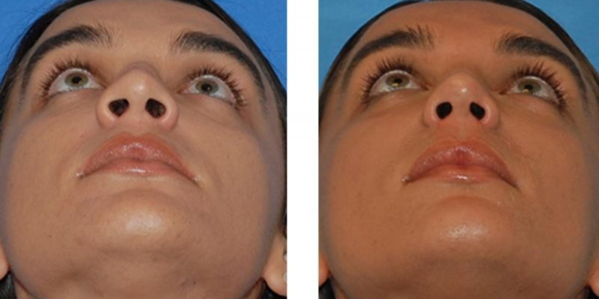 Slim Down with Non-Surgical Fat Reduction in Riyadh