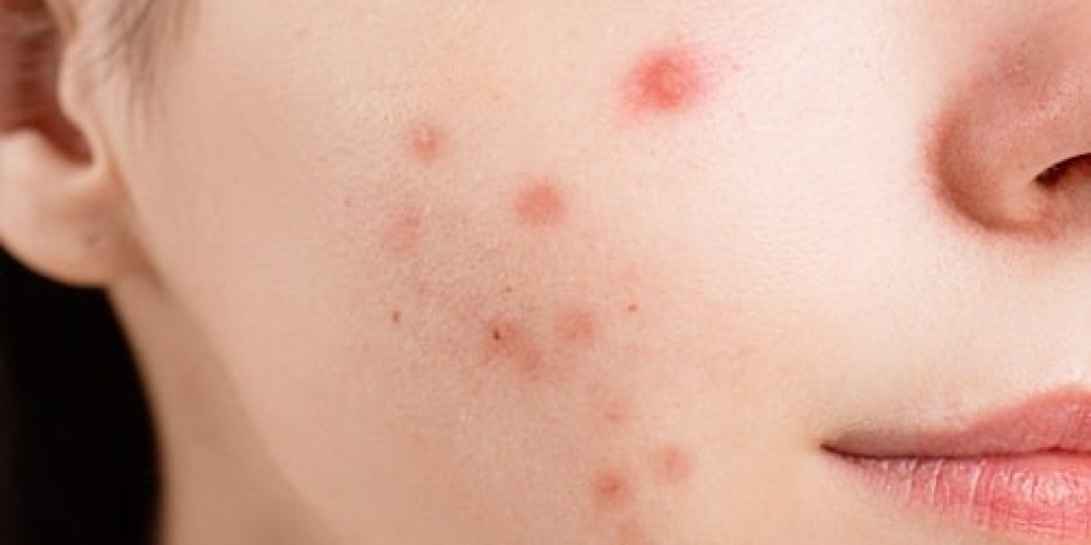 Top Acne Treatments in Dubai: Solutions for Every Skin Type