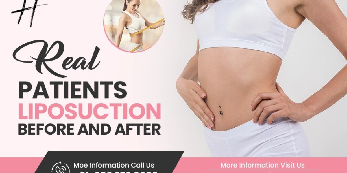Real Patients’ Liposuction Before and After: Understanding the Transformative Journey