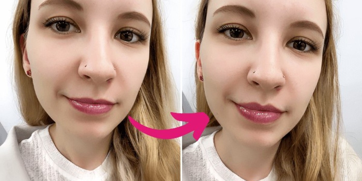 Enhance Your Smile: A Complete Guide to Lip Fillers Southampton