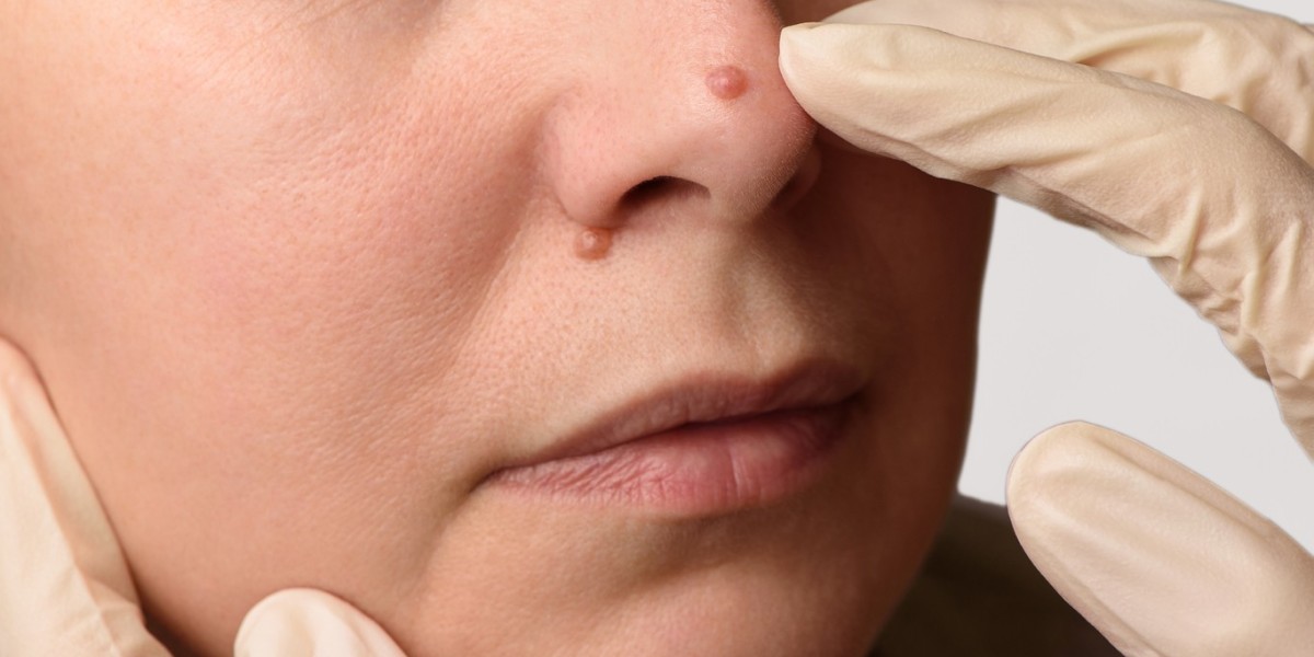 Is mole removal effective on raised moles?