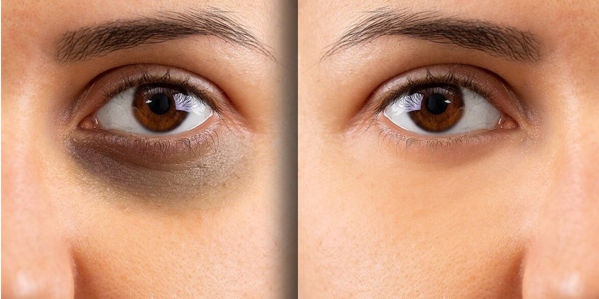 Mesotherapy for Dark Circles in Riyadh: A Quick Overview