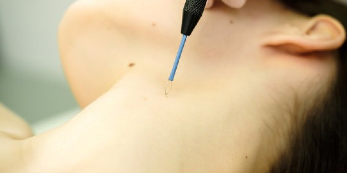 The Most Effective Ways to Remove Warts in Dubai