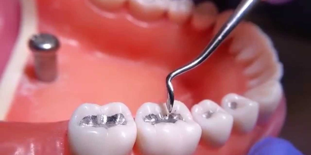 Tooth Filling Materials Market Developments and Innovations: Tracking New Product Launches and Market Shifts
