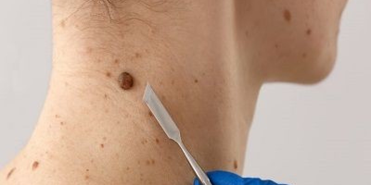Modern Remedies for Wart-Free Confidence