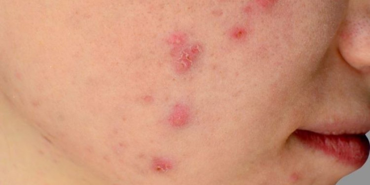 Beauty Beyond Breakouts: Elevate Your Skin with the Right Acne Treatment