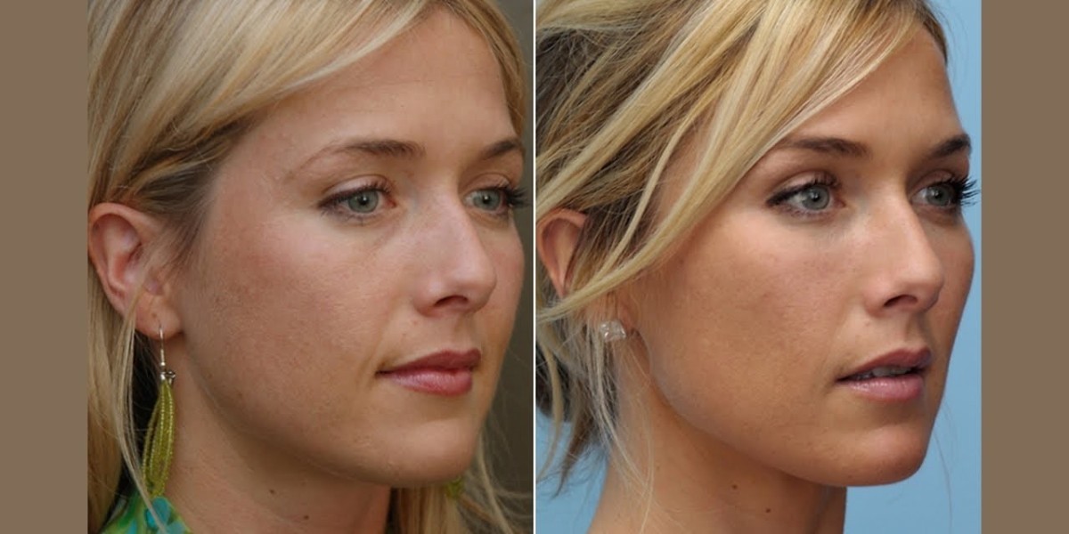 Discover the Best Doctors for Cheek Fillers Injections in Riyadh